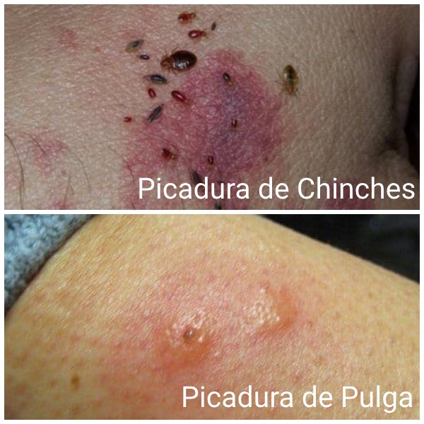 fotos de picaduras de chinches y pulgas